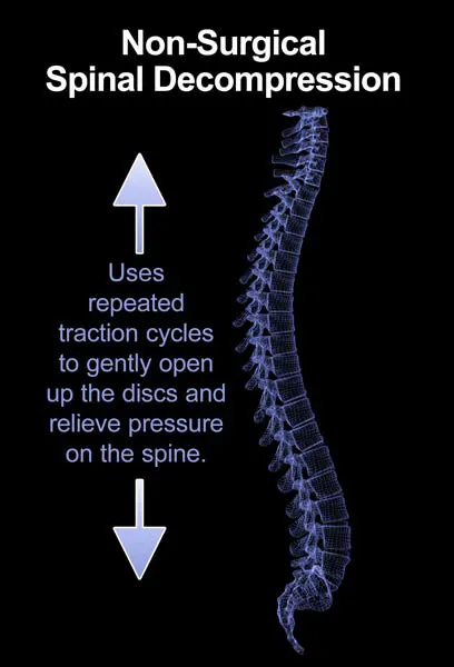 Non surgical spinal decompression in grants NM